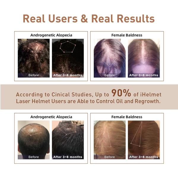 Laser Hair Growth System (FDA Cleared), Hair Regrowth Helmet & Laser Cap, Hair Loss Treatment for Men and Women, Low Level Laser Therapy for Hair Growth, Anti-Thining Treatment